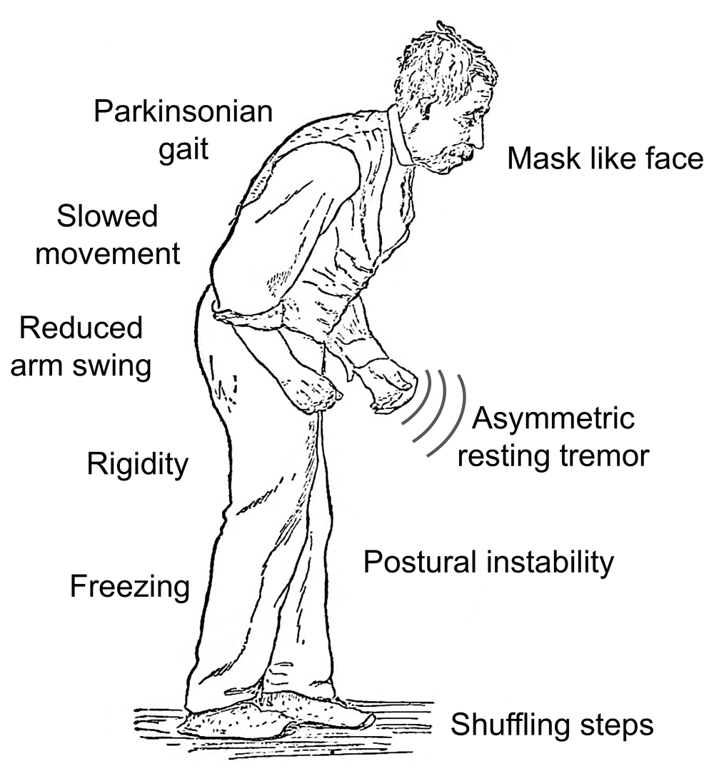 Symptoms of Parkinson Disease
