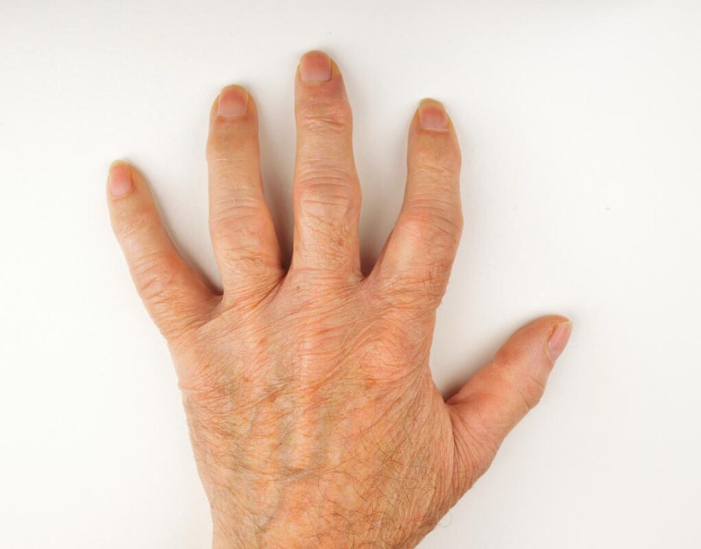 NATURAL WAY TO TREAT ARTHRITIS