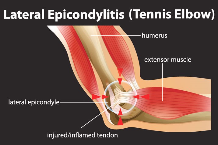Tenis Elbow, Elbow Pain; Weak Elbow