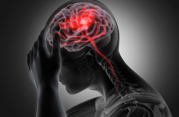 migraine Headache. severe head injury
