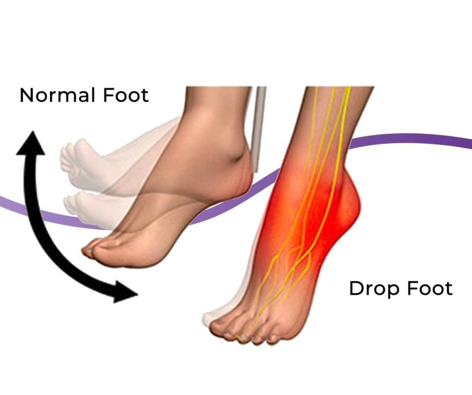 foot pain, drop of foot, bending foot
