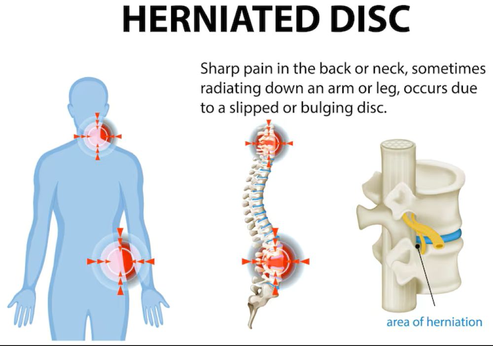 Disc Herniation Physiotherapy Treatment