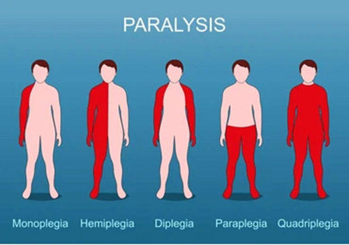 Partial or Total Paralysis Physiotherapy Treatment